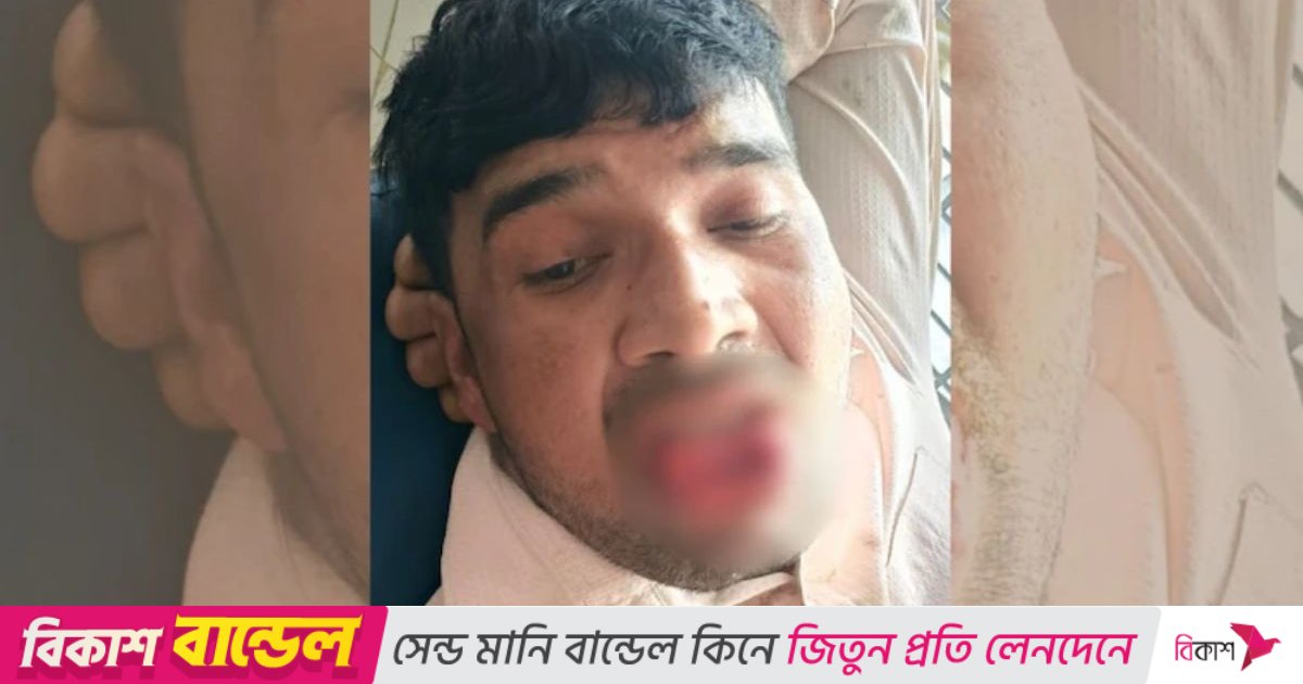 সাবেক প্রেমিকাকে চুমু, কামড়ে ছিন্ন প্রেমিকের জিহ্বা