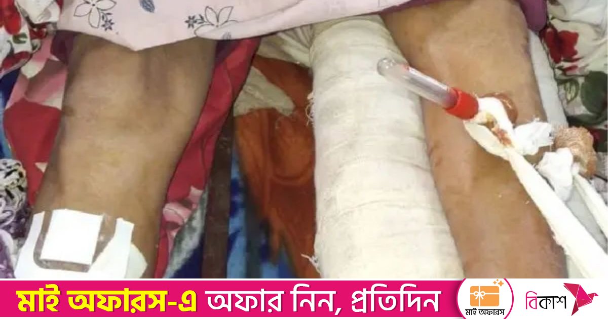 বাঁ পায়ের হাড় ভেঙে যাওয়া রোগীর ডান পায়ে অপারেশন করলো ডাক্তার!