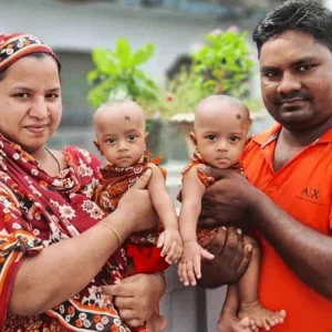 সফল অস্ত্রোপচারে পৃথক হলো জমজ জুহি ও রুহি