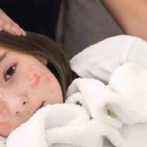 হাম হলে কী করবেন