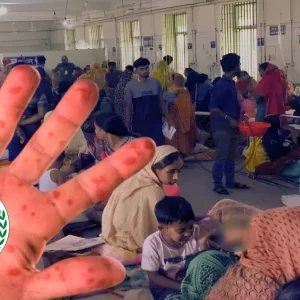 হাম ও হামের উপসর্গ নিয়ে দেশে আরও ১১ শিশুর মৃত্যু