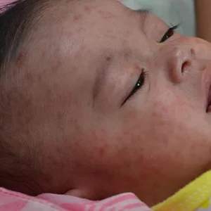 হামের সংক্রমণ আরও এক মাস থাকবে