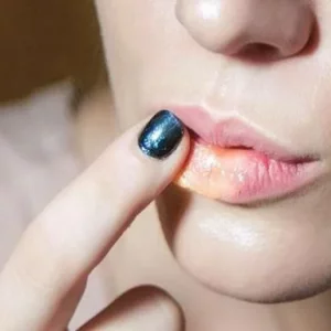 গরমে ঠোঁট ফাটলে কী করবেন