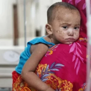 হামের উপসর্গ নিয়ে আরও ৩ জনের মৃত্যু