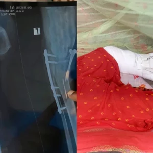 নারীর ভাঙা পায়ের ভেতর ড্রিল মেশিনের ফলা রেখেই সেলাই দিলেন ডাক্তার