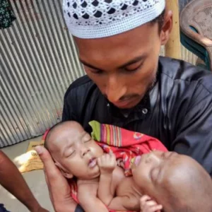 বাঁচানো গেলো না জোড়া লাগা সেই যমজ শিশু দুটিকে
