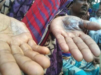 আগুনে হাত পুড়ে গেছে একজন নারীর