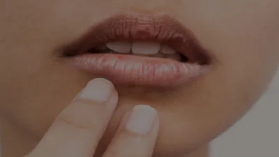 ঠোঁটের কালো দাগ ক্যানসারের লক্ষণ হতে পারে