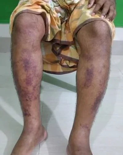 নির্যাতনের শিকার ভুক্তভোগী সাদ্দাম চোকদার। ছবি: সংগৃহীত