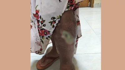 কল্পনার শরীরে নির্যাতনের ক্ষত