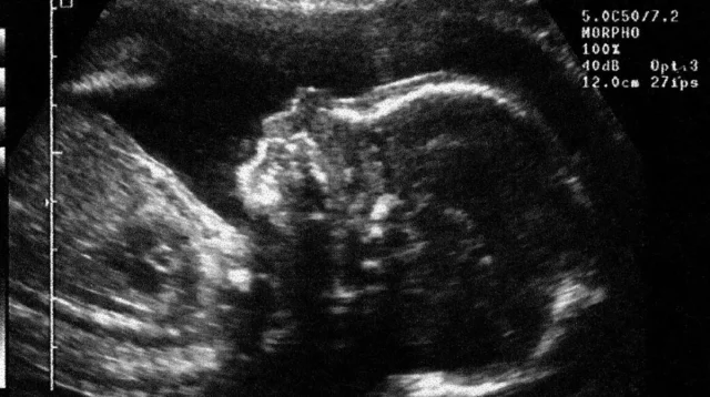 গর্ভে থাকা শিশুর ফুসফুসে টিউমার অস্ত্রোপচার ছাড়াই ছোট করে দেওয়ার নতুন পদ্ধতি উদ্ভাবন করেছেন চীনের চিকিৎসকেরা। ছবি: এএফপি